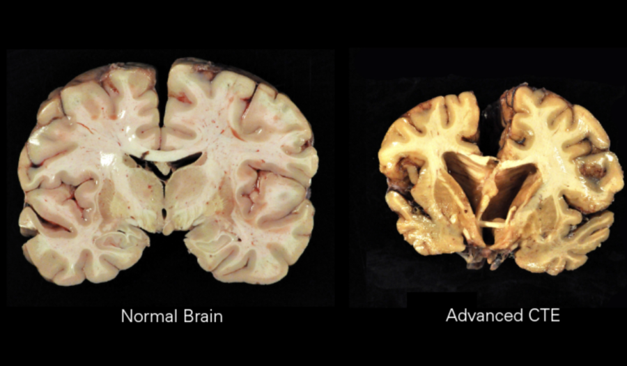 CTE: A Growing Problem?